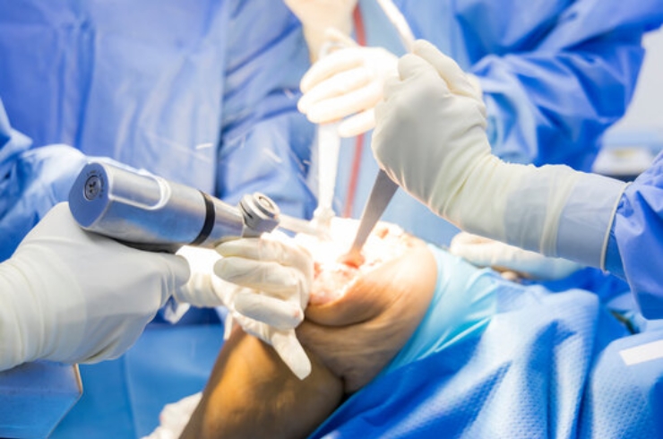 Joint-Replacement