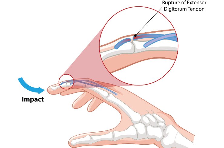Mallet Finger